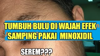 TERNYATA PAKAI MINOXIDIL DAN BIOTIN BAHAYA AUTO BERBULU minoxidil biotin [upl. by Graf]