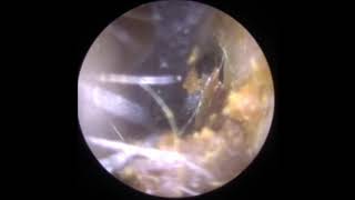 Gentle ear wax removal with Jobson Horne Probe [upl. by Introc]