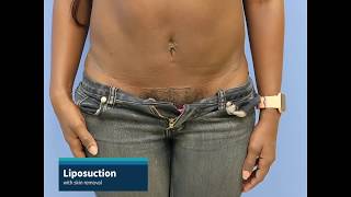 Liposuction with lower tummy skin removal [upl. by Huoh]