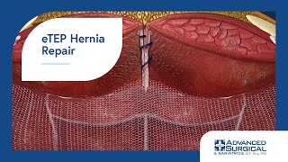 eTEP Hernia Repair [upl. by Severin]