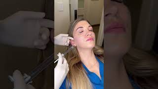 Cheek Filler💉 Dallas surgical Arts 9727764888 Dr Sanovich skincare cheekfiller filler [upl. by Hillery]