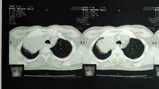 Pancoast tumor  Pancoast syndrome [upl. by Galan]