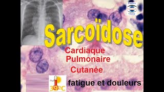 Sarcoidose pulmonaire articulaire renale hepatique cutanée ophtalmologique [upl. by Cyler]