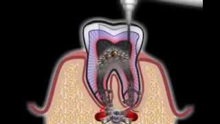 Wurzelbehandlung beim Zahnarzt [upl. by Ilrebmyk]