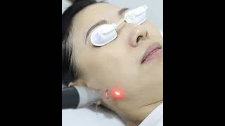 PICO Hybrid Laser Singapore v2  Ace MediAesthetics Clinic [upl. by Aniweta]