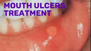 Drugs for mouth ulcers treatment pharmacist pharmacy [upl. by Acinat]