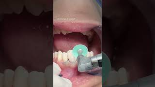 Dental composite veneer satisfying [upl. by Georgie]