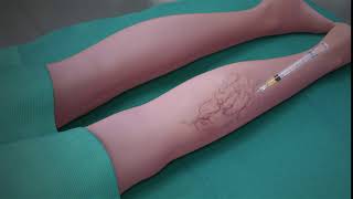 Sclerotherapy Procedure [upl. by Bentley369]