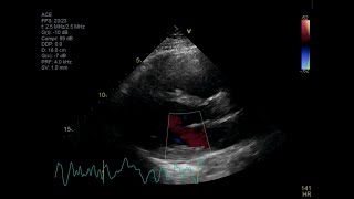 Fatal Giant Cell Myocarditis [upl. by Shamus]