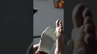 Plantar Wart Removal with Advanced Laser Treatment at Skinaa Clinic Viral Shorts [upl. by Urbannai]