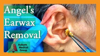 Angels Earwax Removal  Auburn Medical Group [upl. by Lupien705]