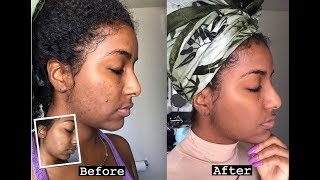 HOW TO CLEAR PIMPLES amp ACNE SCARS IN 1 WEEK [upl. by Osswald]