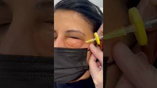 Carboxiterapia facial para las ojeras oscuras [upl. by Assen]