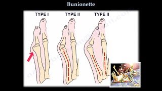 Bunionette  Everything You Need To Know  Dr Nabil Ebraheim [upl. by Adnomal]