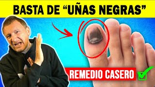 👣 Cómo CURAR una UÑA NEGRA del PIE  hongos en uñas ✅ remedio casero que FUNCIONA [upl. by Amado]