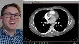 AVALIAÇÃO POR IMAGEM DO TROMBOEMBOLISMO PULMONAR TEP  LIVE 5 [upl. by Ahsoet]