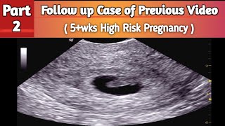 5wks High Risk Pregnancy  Part 2 [upl. by Newlin]