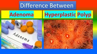 Difference between Adenoma and Hyperplastic polyp [upl. by Kutzenco]