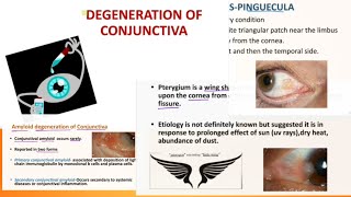 conjunctival degeneration  pinguecula  pterygium concretion ophthalmology  symptoms amp treatment [upl. by Sirret928]