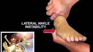 Chronic Lateral Ankle Instability  Everything You Need To Know  Dr Nabil Ebraheim [upl. by Hesky]