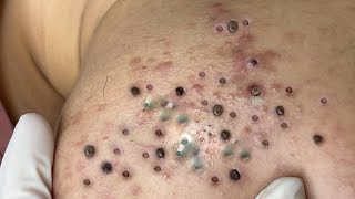 Big Cystic Acne Blackheads Extraction Blackheads amp Milia Whiteheads Removal Pimple Popping  3595 [upl. by Eph123]