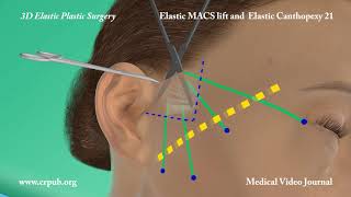 51 Elastic MACS lift and elastic Canthopexy [upl. by Tennek]