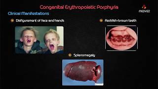 Congenital erythropoietic porphyria  Usmle step 1 Biochemistry webinar lecture [upl. by Duky385]