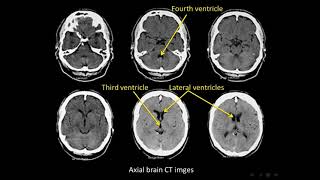 Brain 1 ventricular system  cerebral arteries and veins [upl. by Akinwahs176]