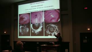 Aspect en endoscopie et échoendoscopie des tumeurs sousmuqueuses digestives  Dr L PALAZZO Paris [upl. by Cupo]