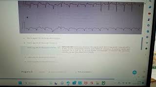 reperfusión en el infarto agudo al miocardio confirmacion evaluación [upl. by Apollus]