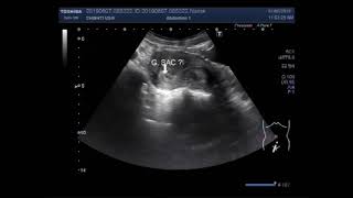 Ultrasound Video showing detection of early pregnancy with decidual reaction [upl. by Nissensohn]