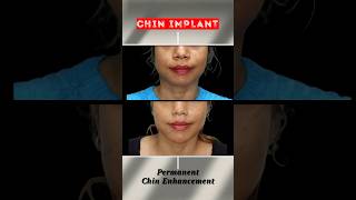 You Wont Believe the Chin Transformation Results from Implants [upl. by Aedrahs]