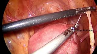 STEP 1  BOWEL AND OMENTAL ADHESIOLYSIS [upl. by Aitak259]