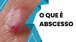 Descubra Tudo Sobre Abscesso e Como Tratar [upl. by Lindberg]