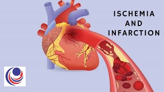 Ischemia and Infarction The difference and Similarities [upl. by Htrow678]