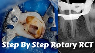 Live Steps Root Canal Rotary Protaper Endodontic Procedure ACP BMP obturation irrigation [upl. by Rechaba]