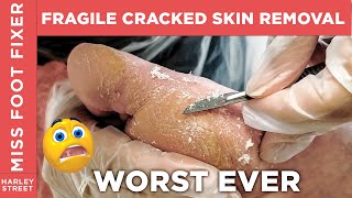 THIN and FRAGILE callus removal callosity removal hard skin removal by miss foot fixer marion yau [upl. by Anelim256]