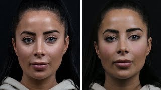 Under Eye Bags Before and After Result  SkinViva Manchester [upl. by Chi]