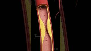 Atherosclerosis viralreels anatomy biology physiotharapist exercise doctorscience [upl. by Livy]