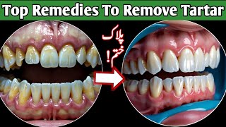 Plaque Removal At Home Easy Remedy  Tartar Removal From teeth [upl. by Nagard]