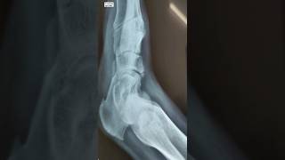 Navicular bone chip fracture viral youtubeshort trending ayurveda [upl. by Mcevoy]