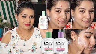 Lacto calamine lotion Honest review demo benefits uses for teenagers men amp women [upl. by Paulson]