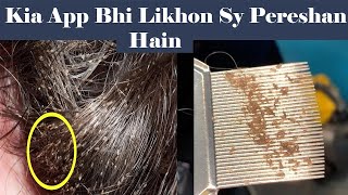 How to Remove Lice from Hair  Effective Lice Treatment amp Nits Removal at Home [upl. by Wurst]