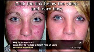 How To Cure Blotchy Skin  Skin Care Tips Blotchy Skin On Face [upl. by Penelopa]