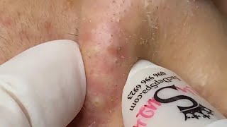 Most satisfying nose acneremoval edit [upl. by Atlee463]