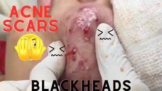 Acne Scarring Blackheads [upl. by Nameerf757]