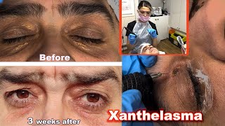 Xanthelasma removal treatment with Plasma Pen  before and after amazing transformation 2023 [upl. by Wack]