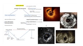 DES instent restenosis mechanisms and interventional management Elias Hanna [upl. by Pedroza]