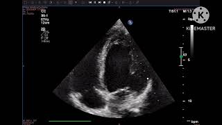 Hypertensive CMP due to fibromuscular dysplasia of renal artery [upl. by Asseneg]