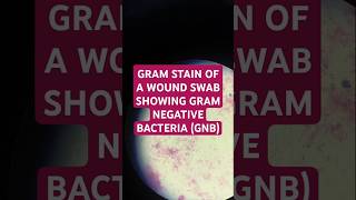 Gramnegative bacteria cause infections in wounds or surgical sites bacteremia mrsa esbl [upl. by Deuno]